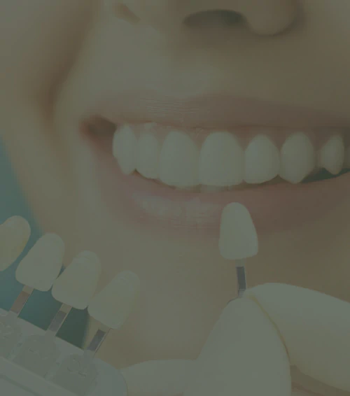 A dentist holding a tooth shade guide against a patients smile.